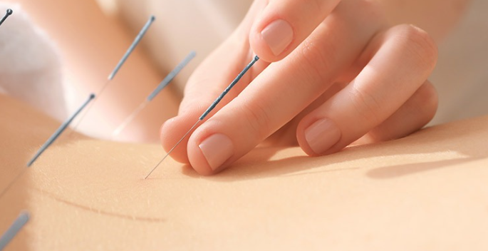 acupuntura